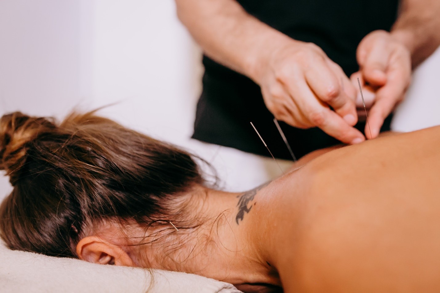 Acupuncture Physiotherapy Treatment