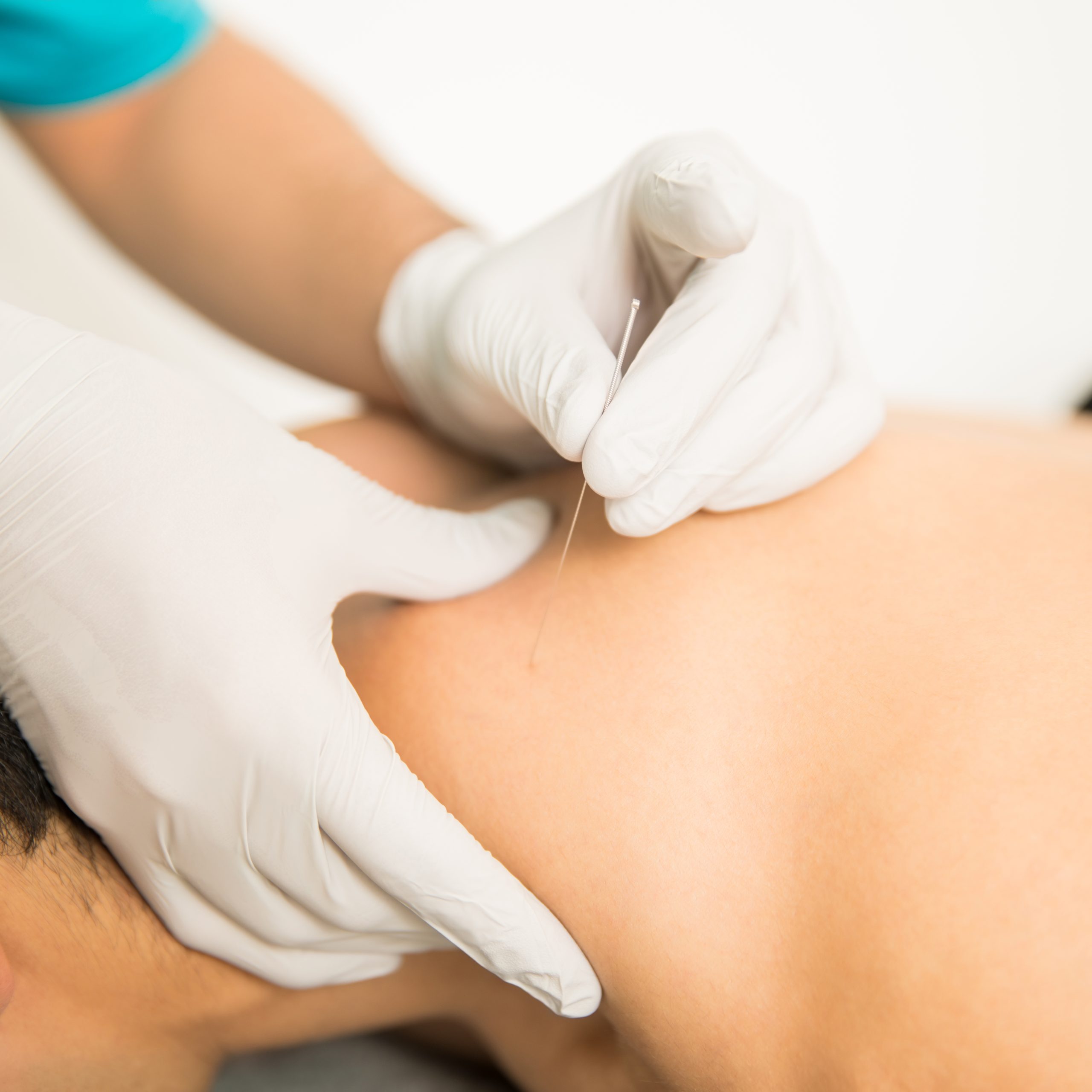 Dry Needling Physiotherapy Treatment