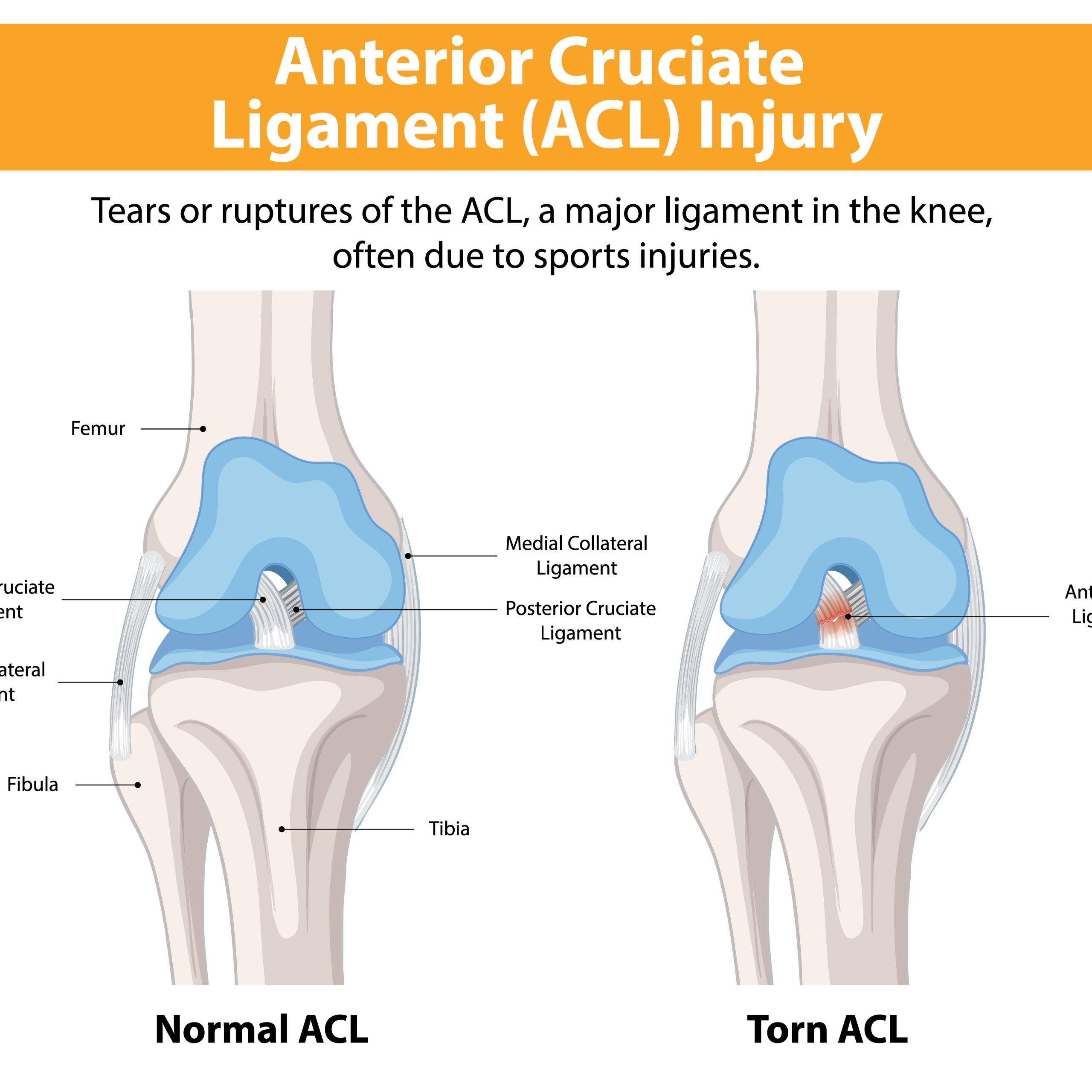 Anterior Cruciate Ligament Acl Injury 1280x720