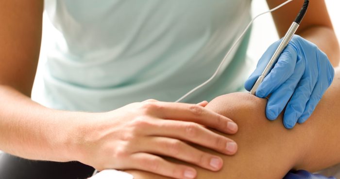 Arthrosamid Injection for Long-Lasting Knee Osteoarthritis Pain Relief