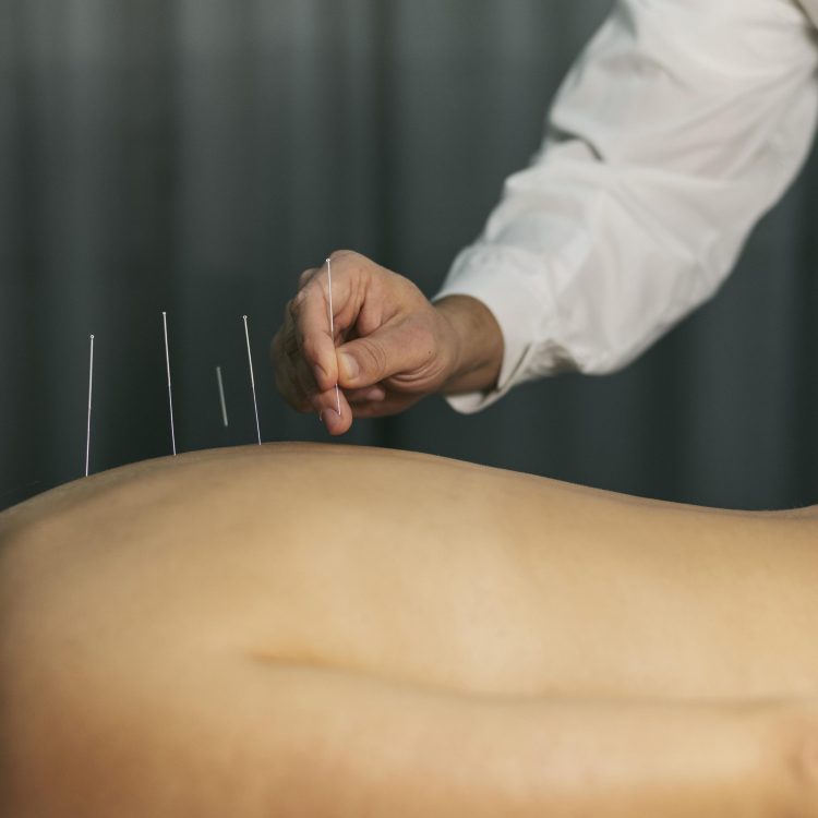 Dry Needling Physiotherapy – The Ultimate Pain Relief Solution